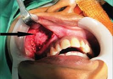 maxillary sinus treatment